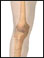 Fracture of the leg