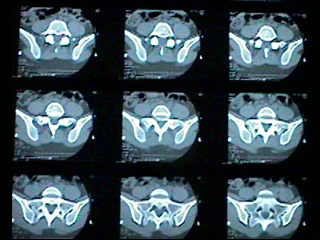 Spine CT