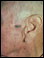 Seborrheic keratosis