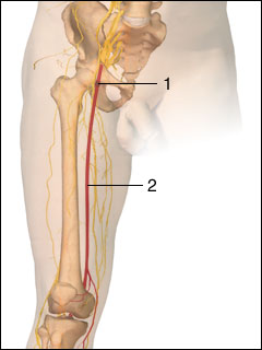 Blood clot (embolus) in the femoral artery of the leg