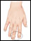 Osteoarthritis of the finger joint