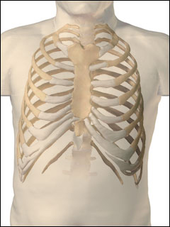 Costochondritis