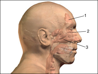 Inflammation of the ethmoid sinuses