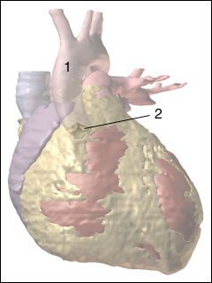 Aortic valve insufficiency