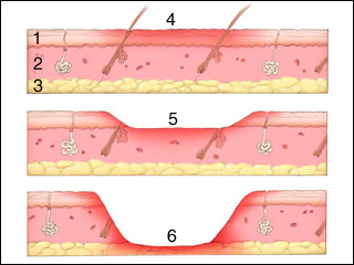 Different types of burns