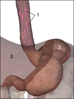 Bleeding oesophageal varices (varicose veins)