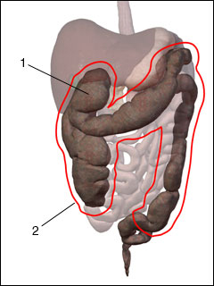 Toxic megacolon