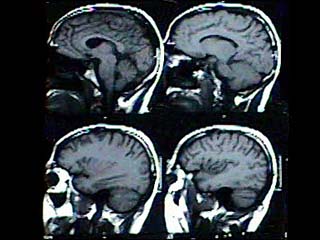 Cranial MRI