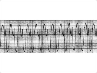 Electrocardiogram of ventricular tachycardia