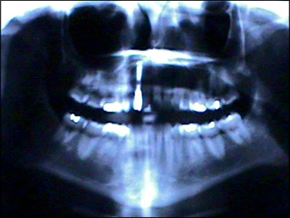 Dental X-rays