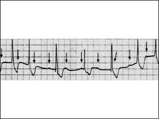 Electrocardiogram of paroxysmal supraventricular tachycardia