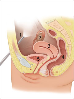 Laparoscopy