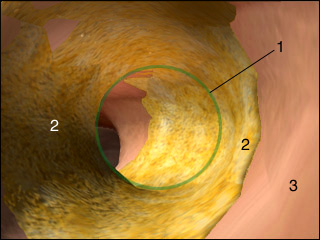 Atherosclerosis, hardening of the arteries