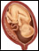 Placenta abruptio