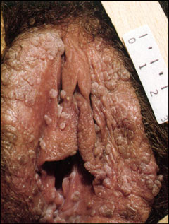 Genital warts (female)