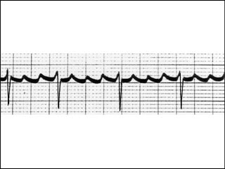 Electrocardiogram showing atrial flutter (rapid heart beat)