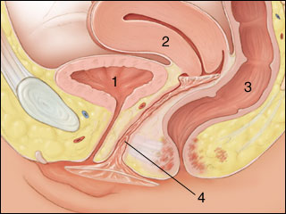 Female condom