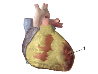 Bruise of the heart muscle