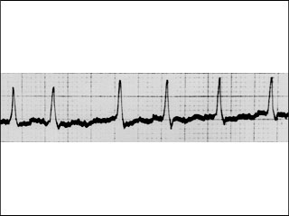 Electrocardiogram showing atrial fibrillation (abnormal heart rhythm)