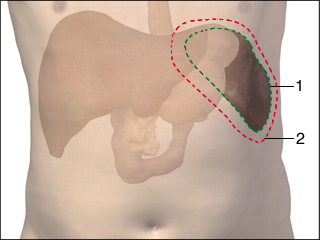 Hypersplenism