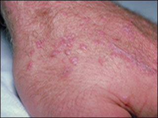 Lichen planus