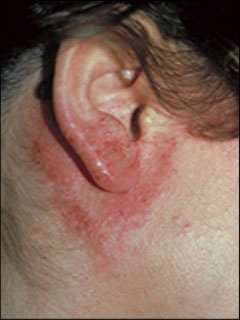 Contact dermatitis (on the external ear)