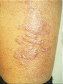 Stasis dermatitis