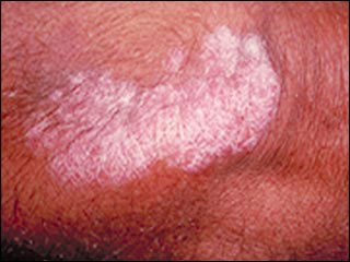 Psoriasis