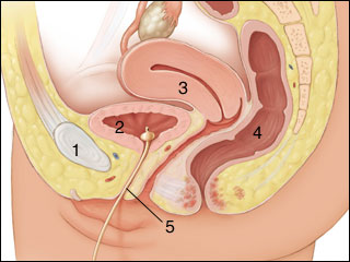 Urinary catheters