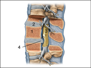 Herniated disk