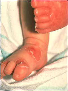 Scalded skin syndrome