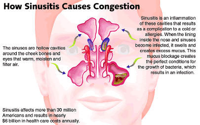 Is it sinusitis?