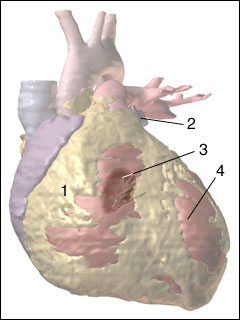 Mitral valve regurgitation; acute