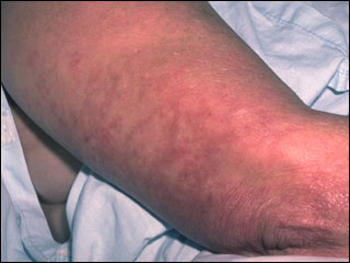 Idiopathic or primary livedo reticulitis