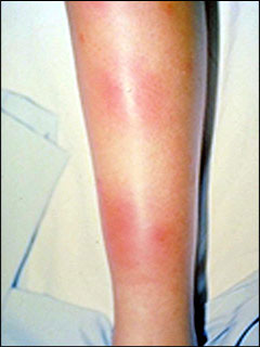 Erythema nodosum