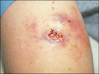 Skin lesions of sporotrichosis