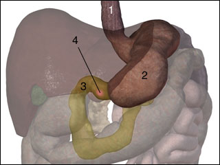 Ulcer in the duodenum (small intestine)