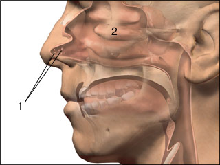 Nasal polyps