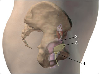 Bladder stones