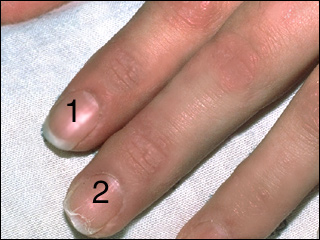 Brittle nails