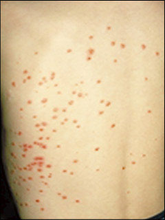 Psoriasis guttate