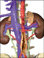 Aortic dissection/tear in the aortic vessel wall