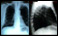 Chest X-ray (front and side views)