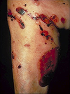 Bullous pemphigoid