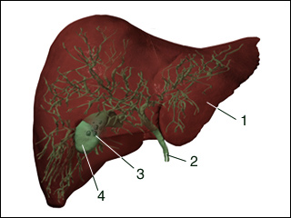 Gallstones in the gallbladder (cholelithiasis)