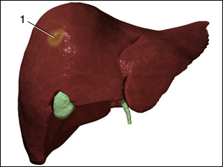 Pyogenic liver abscess