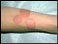Contact dermatitis (on the arm)