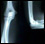 Joint X-ray of elbow
