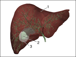 Inflamed gallbladder