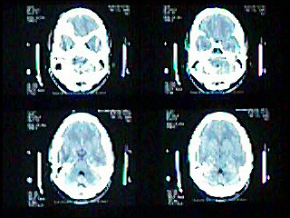 Cranial CT